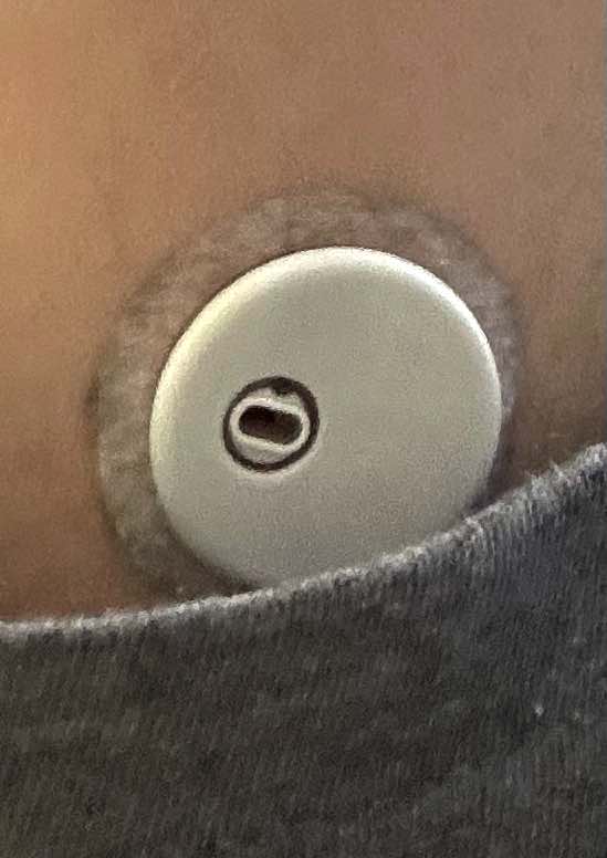 A picture of a CGM sensor attached to the skin